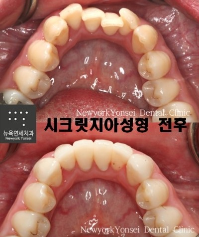 [치아성형] 시크릿 치아성형(라미네이트)