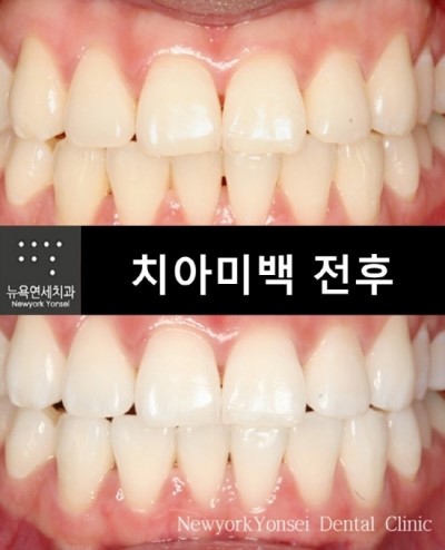  치아미백, 치아미백잘하는곳