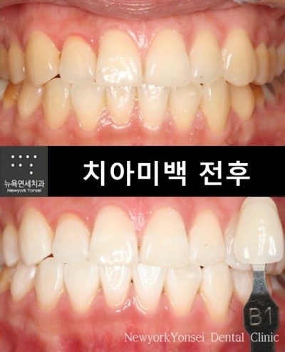 [치아미백 Q&A] 치아미백문의 - 치아미백후 밝기 변화와 이 시림 정도는?