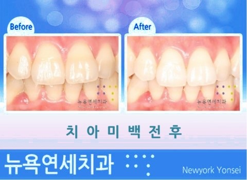  면접전 치아미백 치과 잘하는곳