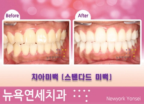 [원데이 치아미백 전문] 치아미백 전후사진