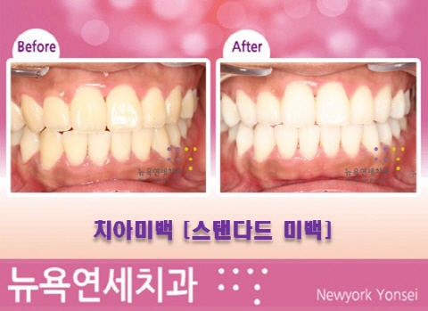  [원데이 치아미백 전문] 치아미백 전후사진