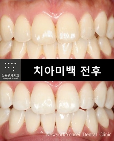 [뉴욕연세치과Q&A] 치아미백통증 어느정도인가요?