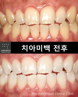  줌 치아미백 잘하는곳