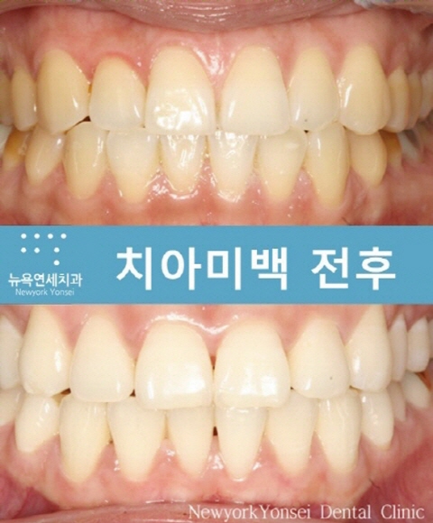  연예인 치아미백 종류