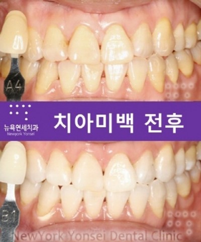[강남역 치과 치아미백] 치아화이트닝 전문