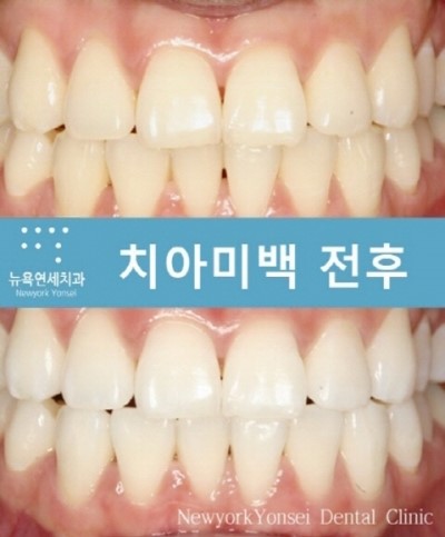  스케일링 치아미백 폴리싱