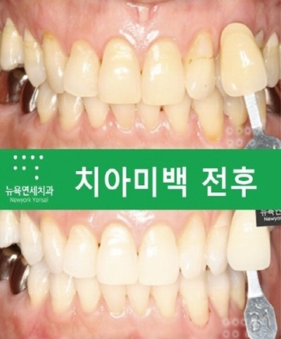  [치아미백Q&A] 스탠다드 치아미백 기간, 횟수, 가격문의