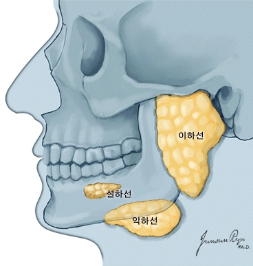 갑상선암투병기. 방사능동위원소치료후유증.. 동위 4개월차에 침샘염이오다니..