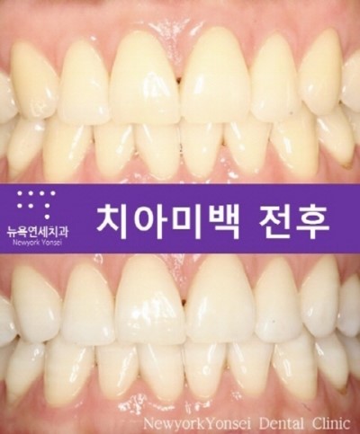 [강남치아미백치과] 치아미백 전문치과