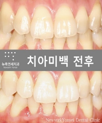  [뉴욕연세치과 치아미백 Q&A] 결혼전 치아미백