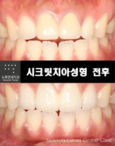  라미네이트전문치과 / 라미네이트가격