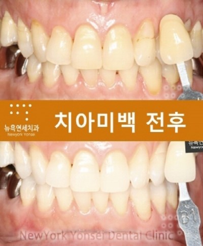  [치아미백] 원데이치아미백 전후사진