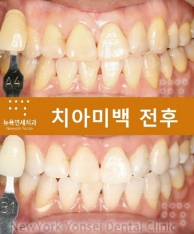  원데이치아미백 가격