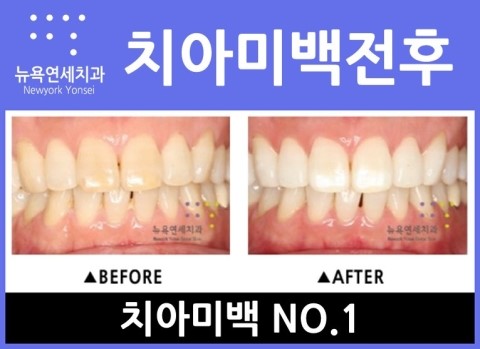  치아미백 가격