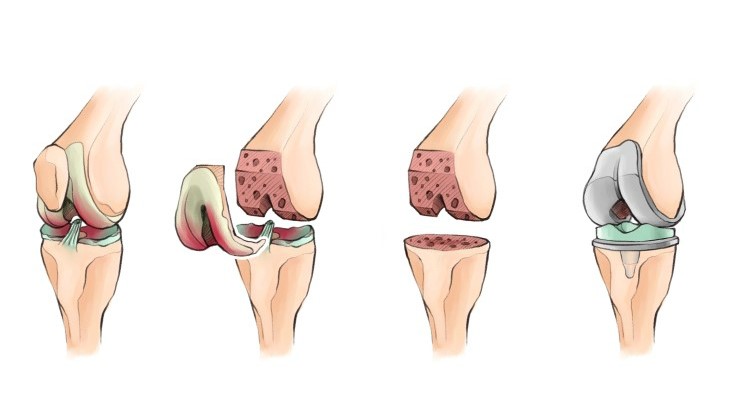  메디컬일러스트_슬관절 인공관절 치환술 (TKR)