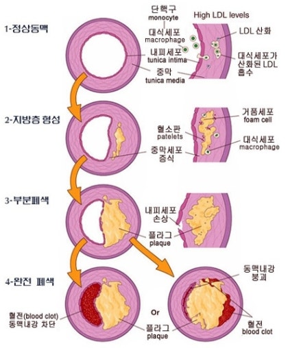 동맥경화의 원인과 증상을 조사해 주세요