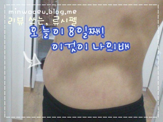 명동비만클리닉 진행중 복부지방분해주사 후기
