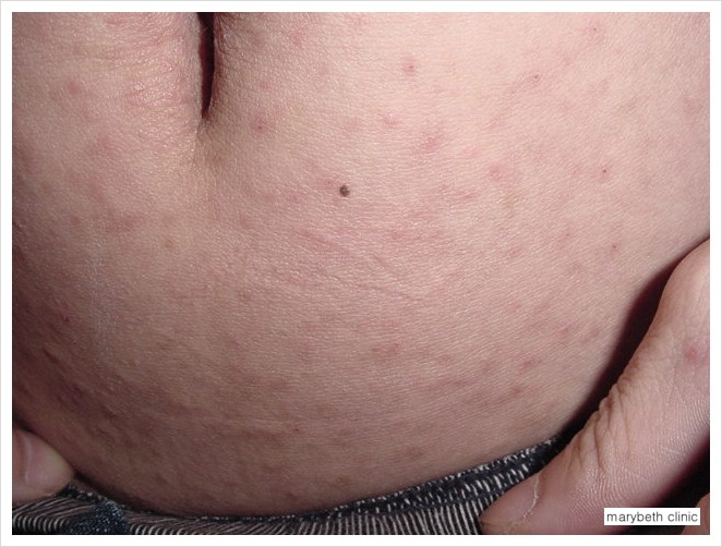 밤에가려움으로 고통스러우신가요?! 4