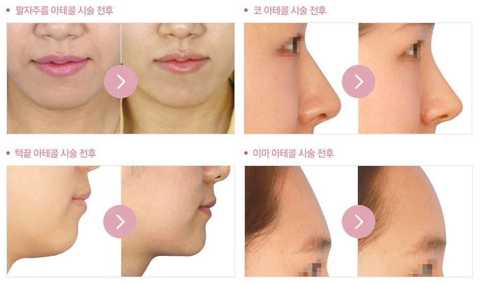 범계성형외과 자연스러운 대세 코필러 유지기간 3