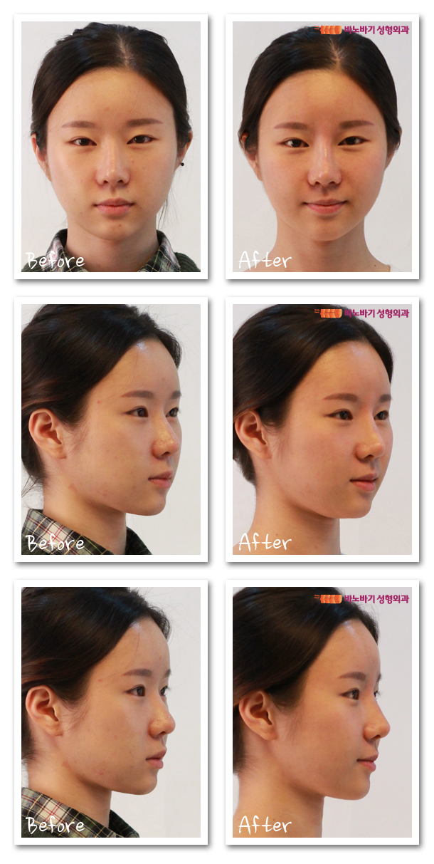 범계성형외과 자연스러운 대세 코필러 유지기간 4