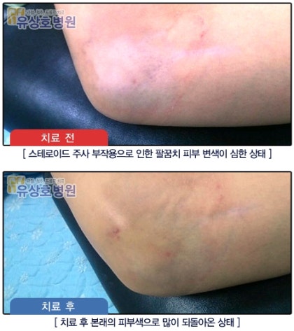 무릎 관절염을 예방하는 뼈주사 연골주사