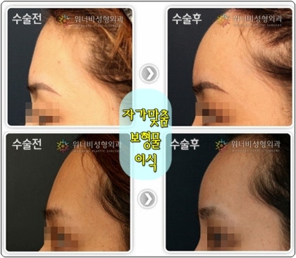 광주 이마거상 수술과 보형물 제거로 문제 해결 2