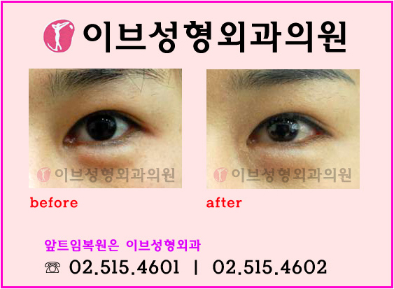 안각재건술을 고려하고 계시다면 압구정성형외과 8