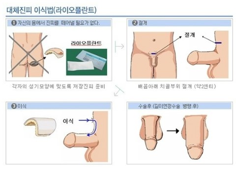 [ 대체진피 ] 라이오플란트 확대효과 !!! 안전성 !!! 부작용 !!!