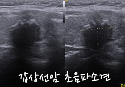 [준희 아빠] 40대 남자 갑상선암 진단받는