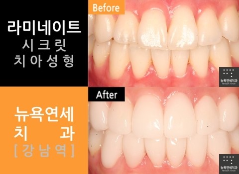 [치아성형] 무삭제라미네이트와 미소라인 치아성형