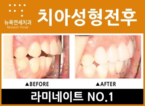 [치아성형] 시크릿 올세라믹 치아성형