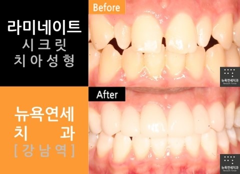 [시크릿치아성형] 스마일라인을 만드는 치아성형과 잇몸성형 그리고 치아미백