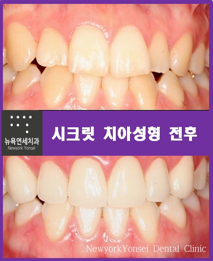 [강남역치과 치아성형]아름다운 미소를 완성하는 치아성형