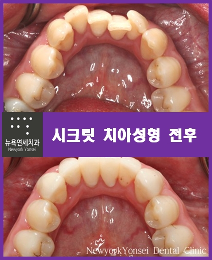 [강남역치과 치아성형] 자신감있는 미소를 위한 치아성형