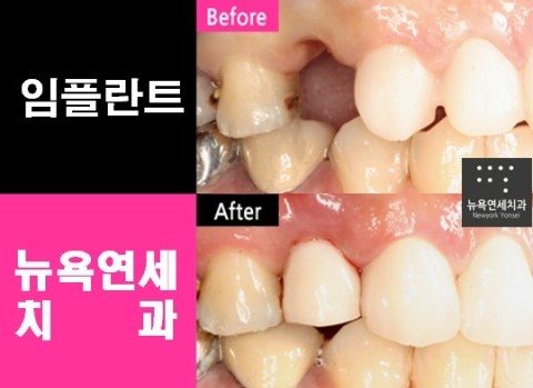  [임플란트] 맞춤형 임플란트