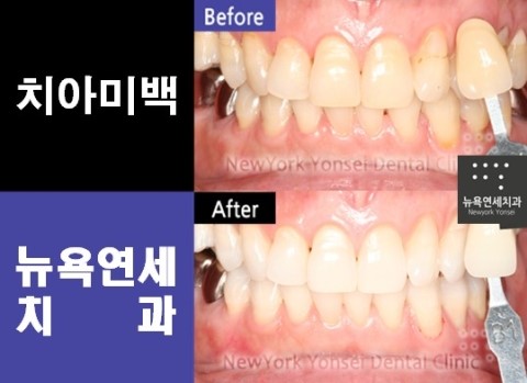 [뉴욕연세치과 치아미백후기] 정은미님 치아미백 시술후기