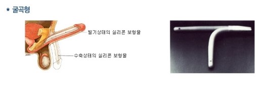  (강동구 발기부전/천호 발기부전) 발기부전 음경보형물 삽입수술 - 강동구발기부전치료/천호발기부전치료/강남발기부전치료/구리발기부전치료/남양주발기부전치료/중랑구발기부전치료/하남발기부전치료/성남발기부전치료/광진구발기부전치료/송파구발기부전치료/경기도발기부전치료