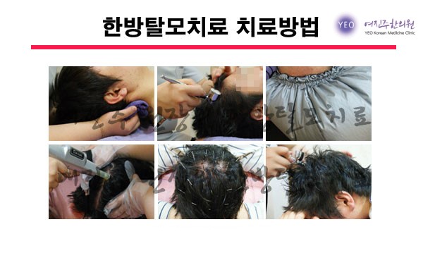 노원탈모 치료 한방으로 원인부터 제대로