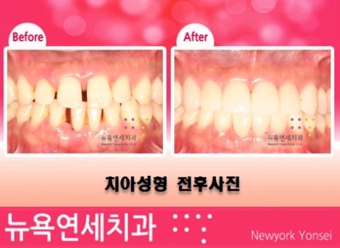  벌어진 치아 라미네이트