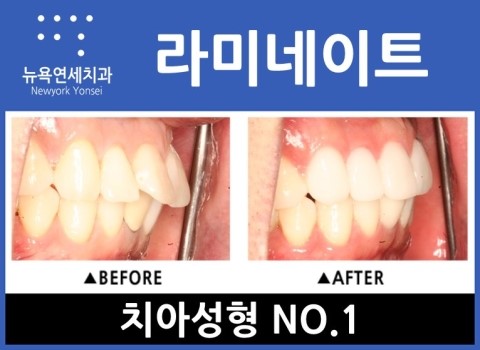 [강남역치과] 치아성형 잘하는곳_라미네이트/올세라믹