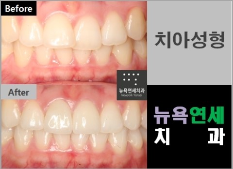  불규칙한 앞니의 치아성형 전후
