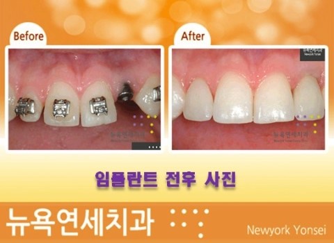  [임플란트] 강남역 임플란트 치과