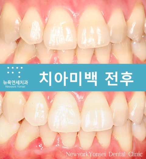 [치아미백]강남역 치아미백