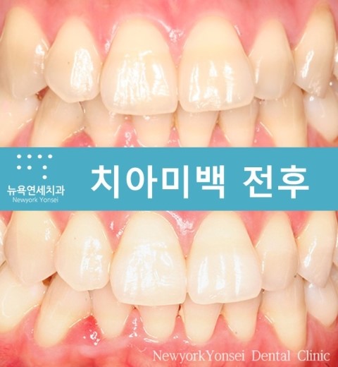  [치아미백]강남역 치아미백