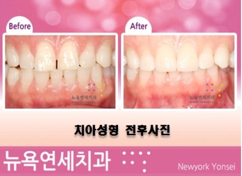 [치아성형] 라미네이트/올세라믹/강남역 치과