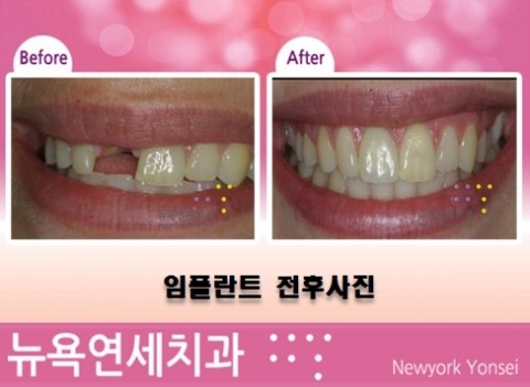  [임플란트] 즉시임플란트/임플란트