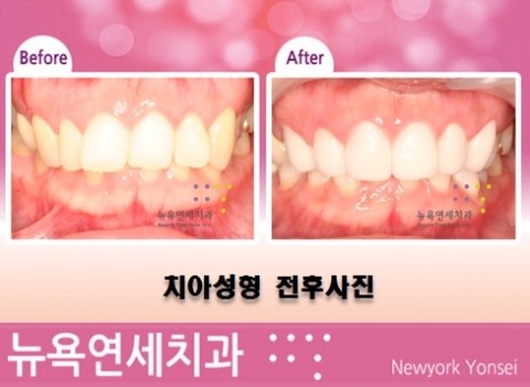  [치아성형] 라미네이트/불규칙한치열/시크릿치아성형