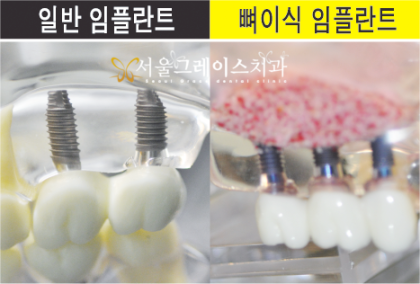 임플란트 뼈이식 통증 지속시간 확인하기