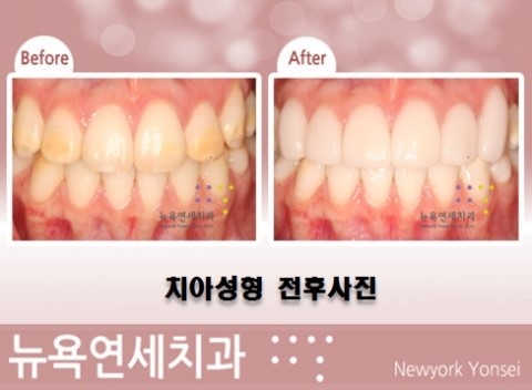  [라미네이트 방법] 앞니 라미네이트 시술 방법은?